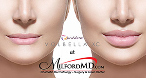 MilfordMD Juvederm Volbella XC By MilfordMD