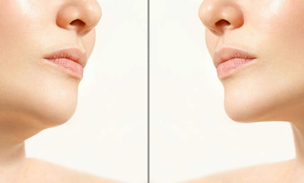 Will Losing Weight Help My Double Chin by MilfordMD