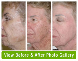 BA Omnilux foto facial in Milford PA