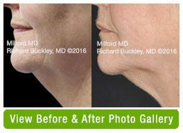 BA Coolsculpting Neckfat in Milford PA