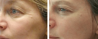 Rejuvenation Phototherapy in Milford PA