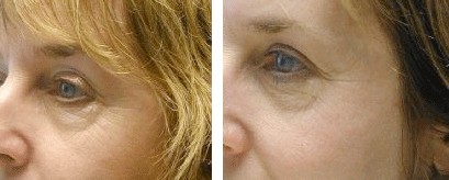 Rejuvenation omnilux in Milford PA
