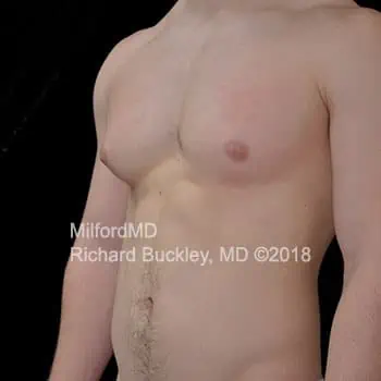 before-treatment-thumb-img