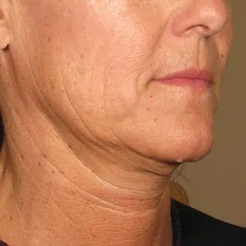 before-treatment-thumb-img