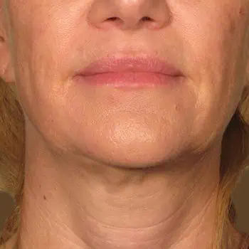 before-treatment-thumb-img