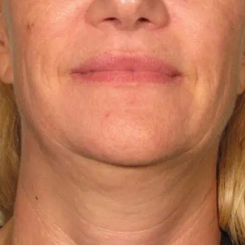 before-treatment-thumb-img