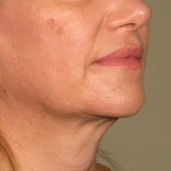 before-treatment-thumb-img