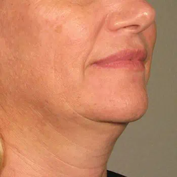 before-treatment-thumb-img