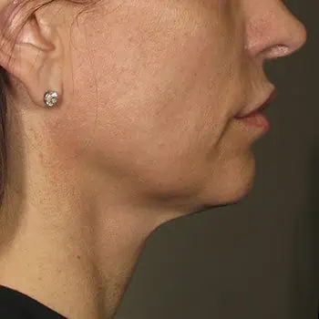 before-treatment-thumb-img