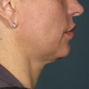 before-treatment-thumb-img
