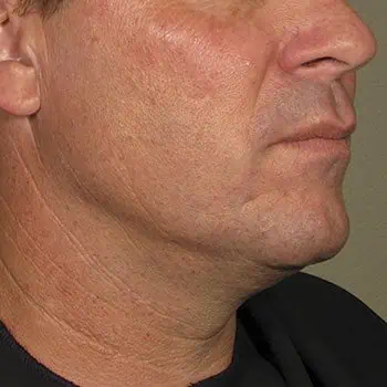 before-treatment-thumb-img