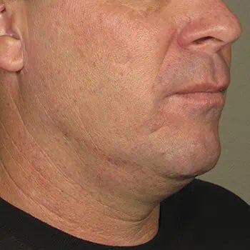 before-treatment-thumb-img