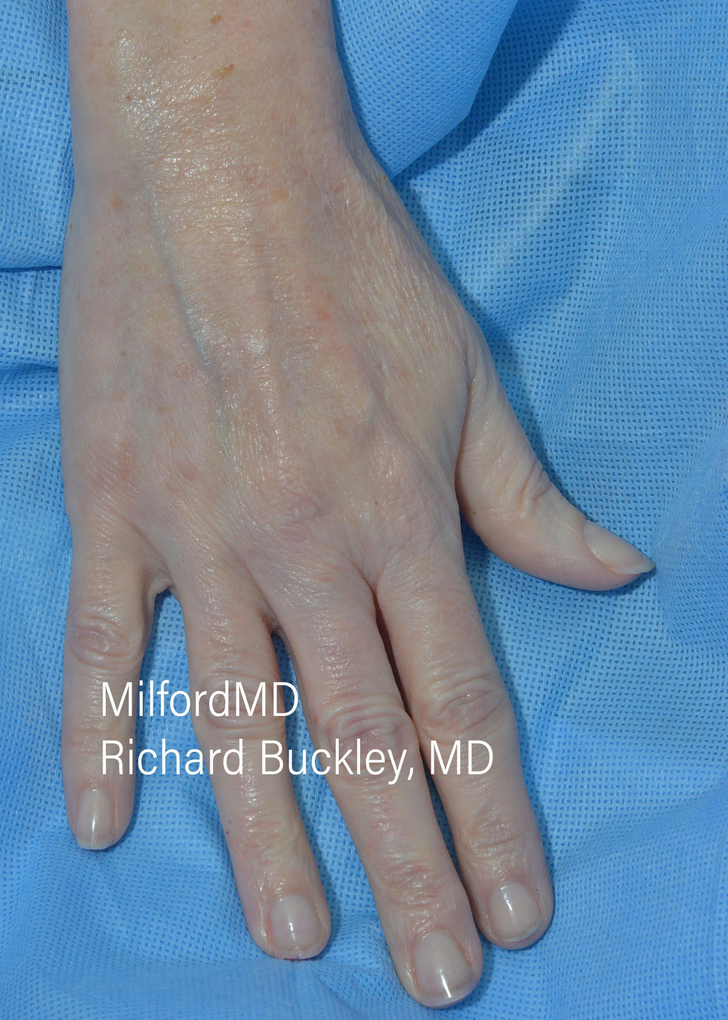 before-treatment-thumb-img