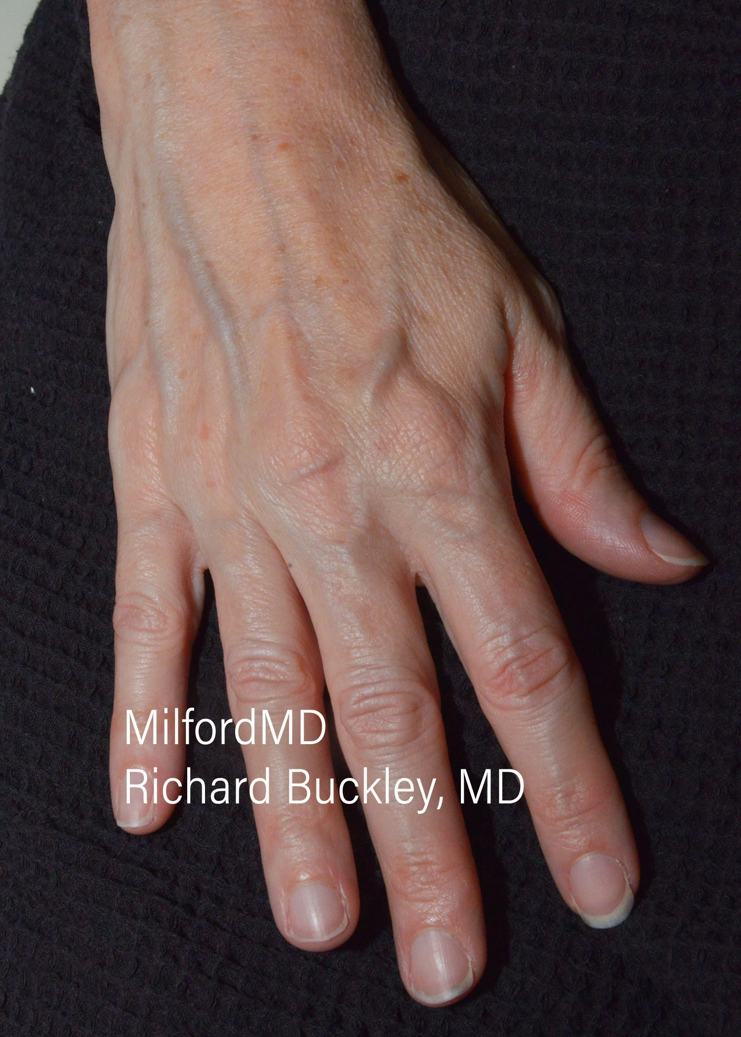before-treatment-thumb-img