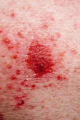 basil cell carcinoma by MilfordMD