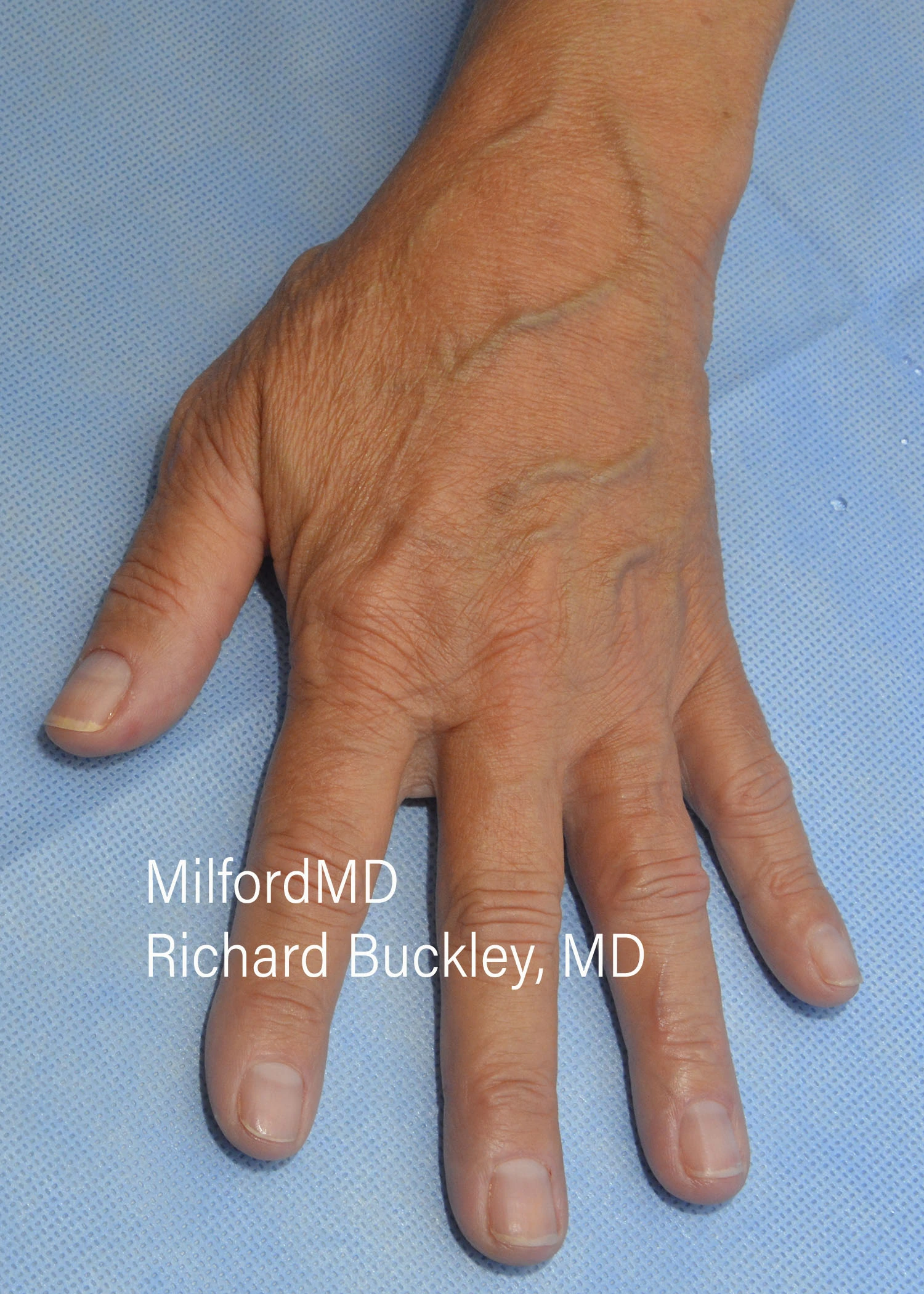 before-treatment-thumb-img