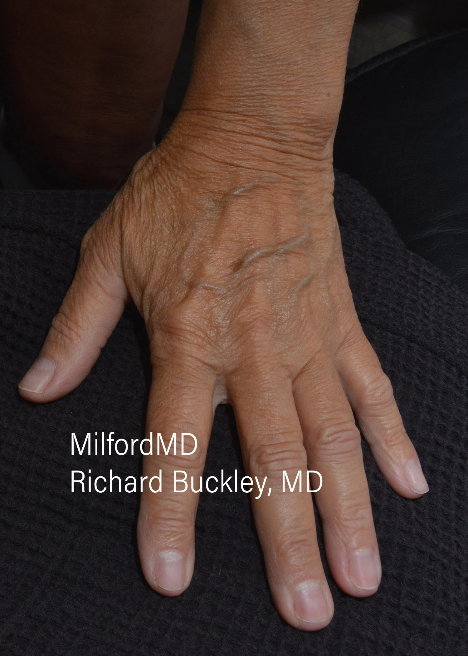 before-treatment-thumb-img