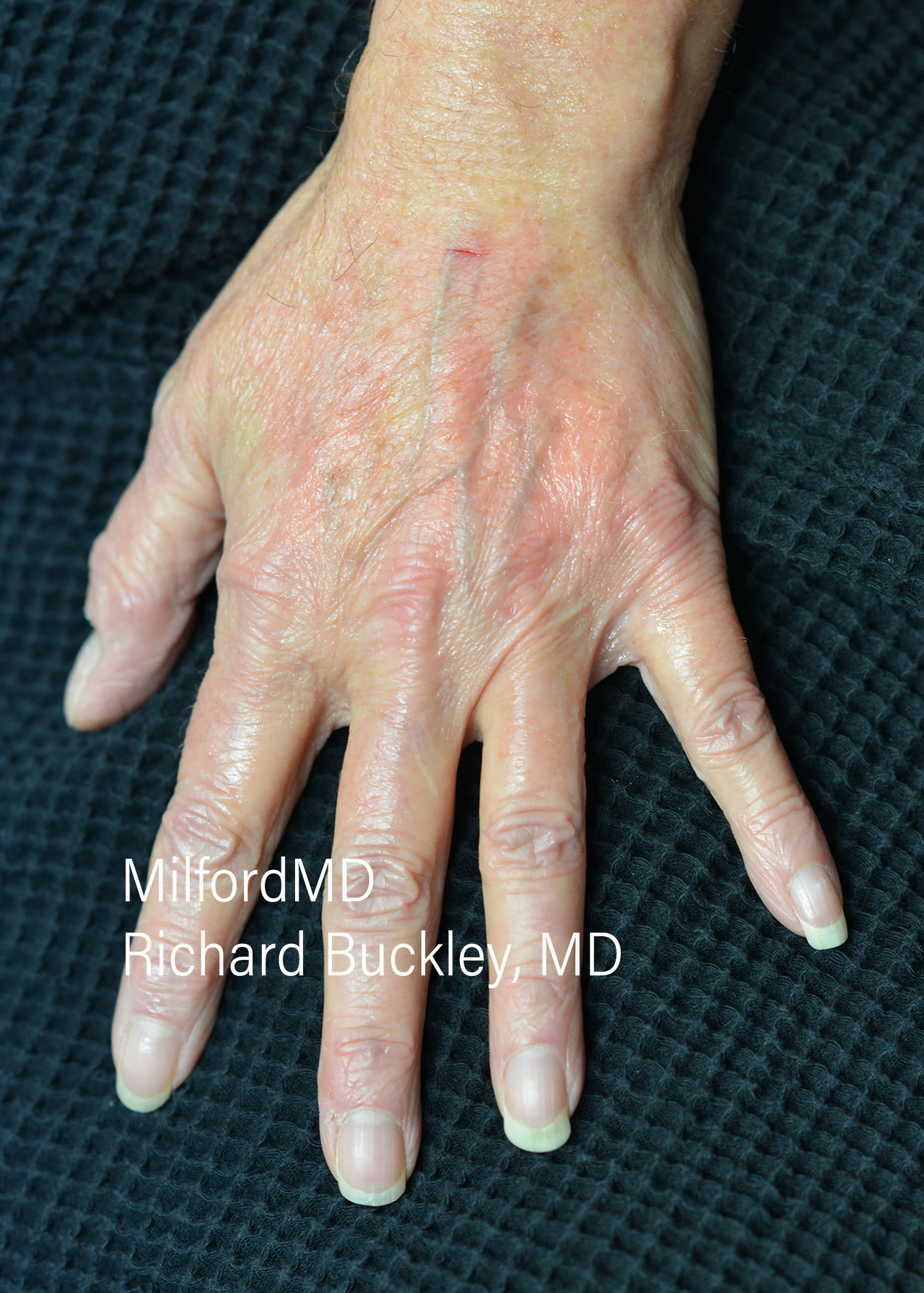 before-treatment-thumb-img