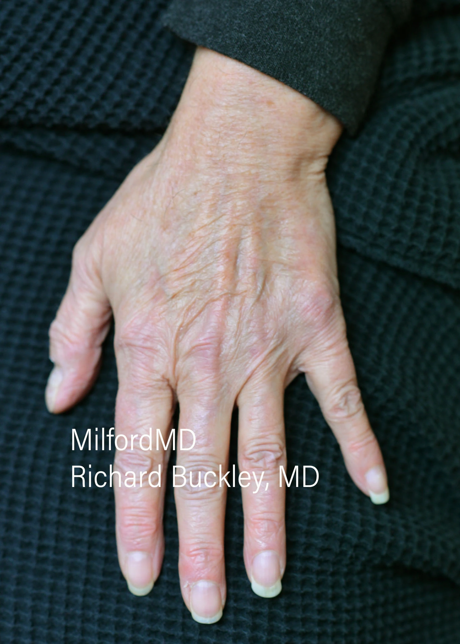 before-treatment-thumb-img