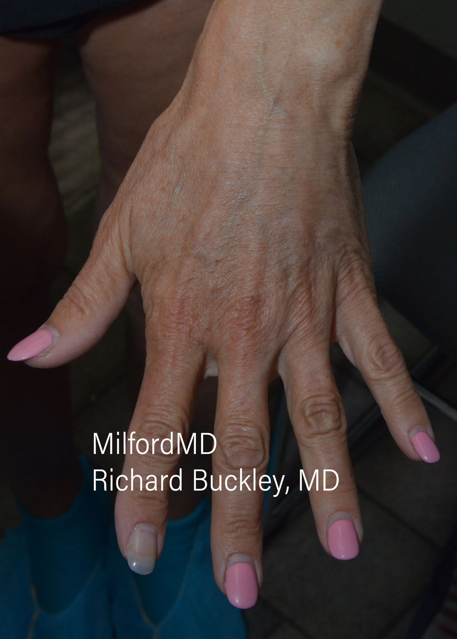 before-treatment-thumb-img