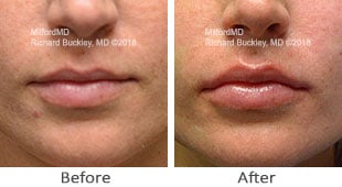 Lip Augmentation by MilfordMD
