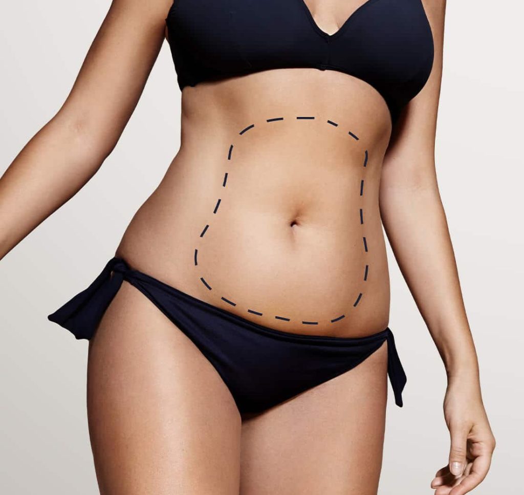 landing smartlipo three by MilfordMD