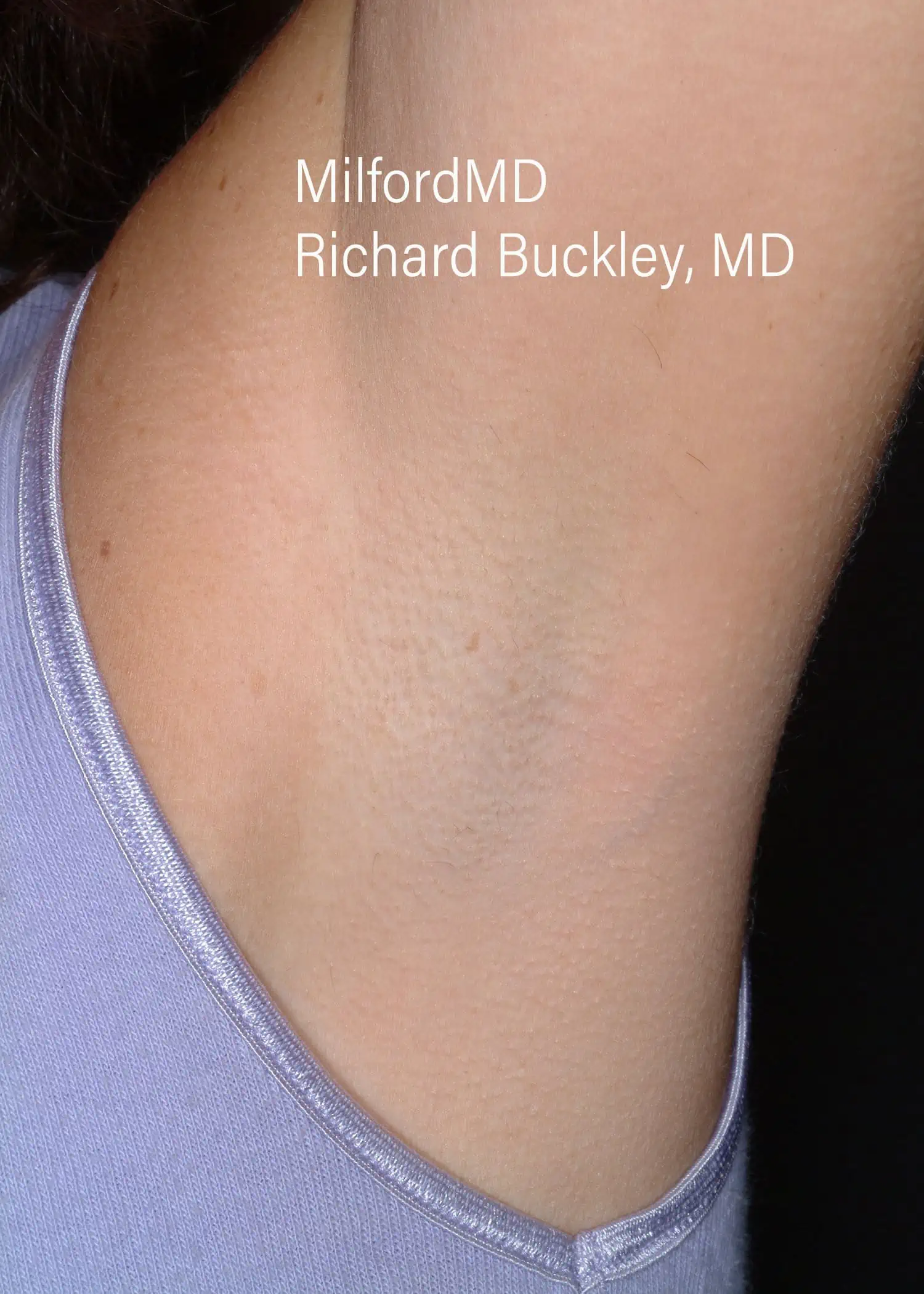 laser-hair-removal-procedures by MilfordMD in Milford, PA