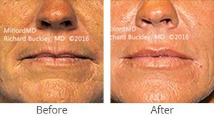 lip augmentation 36129 thumb by Milford