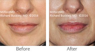 lip augmentation 36130 thumb by Milford