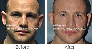 restylane facial filler case 36116 by MilfordMD