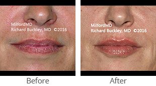 Restylane lip augmentation case 36125 by Milford