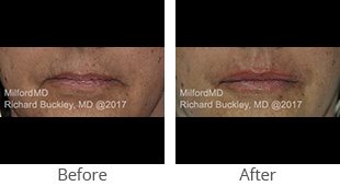 Restylane silk lip augmentation case by MilfordMD