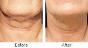 thermage neck tightening 35837 thumb by MilfordMD