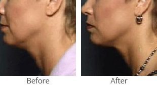 thermage neck tightening 35838 thumb by MilfordMD