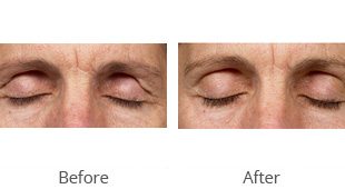 Thermage Eyelid by MilfordMD