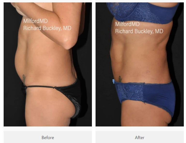 Liposuction-Reshaping-Your-Confidence-MilfordmdMD (3)